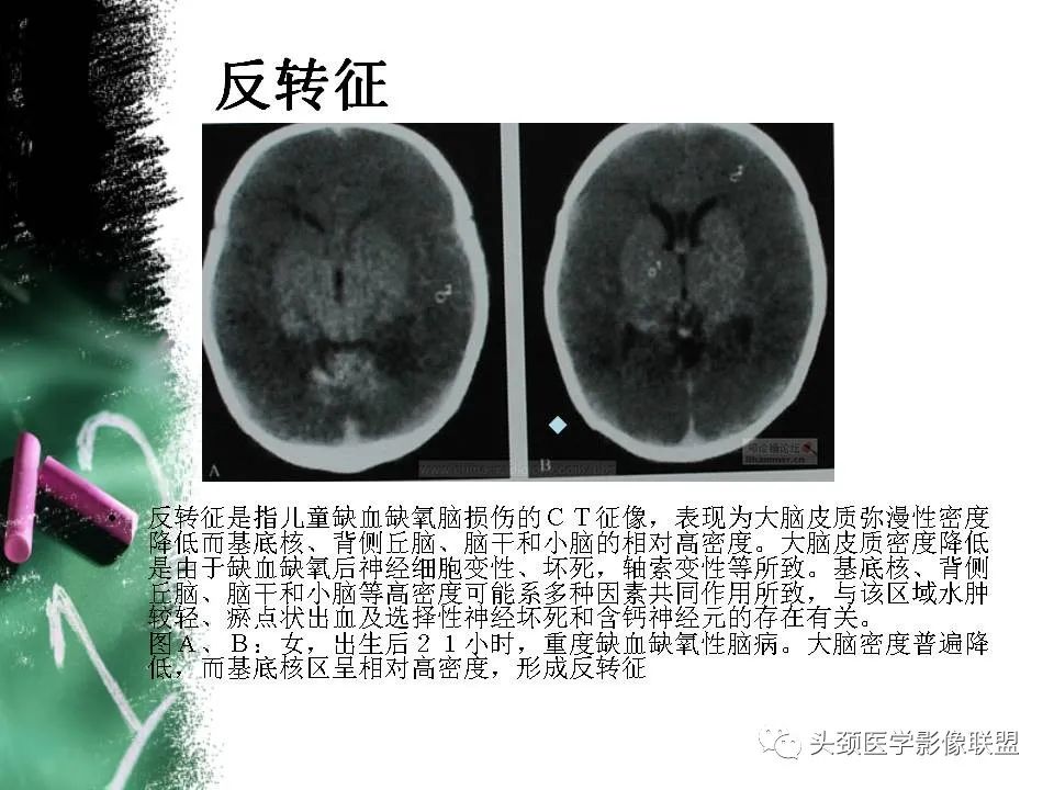 影像PPT - 【PPT】影像异常征象—神经科常见影像征象-73