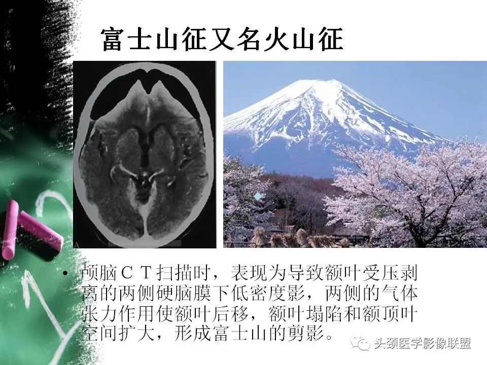 影像PPT - 【PPT】影像异常征象—神经科常见影像征象-74