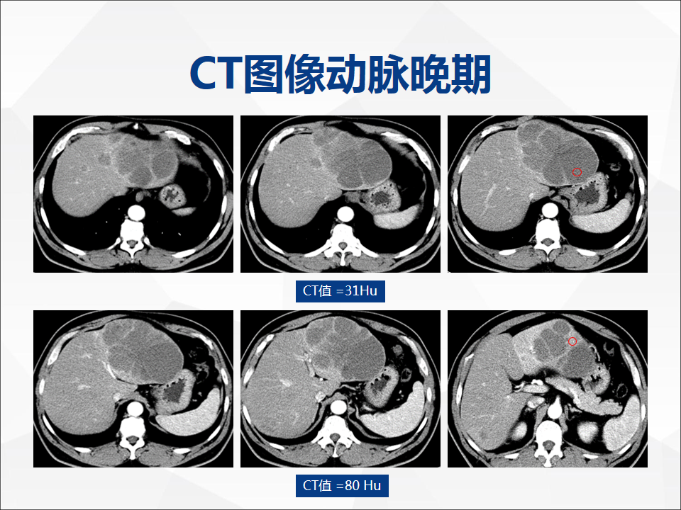 影像PPT - 【病例】肝脏囊性肝细胞肝癌伴转移1例CT及MR-4