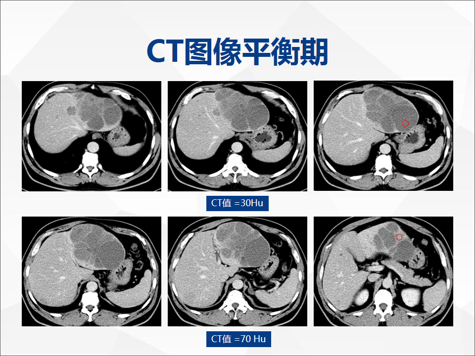 影像PPT - 【病例】肝脏囊性肝细胞肝癌伴转移1例CT及MR-5