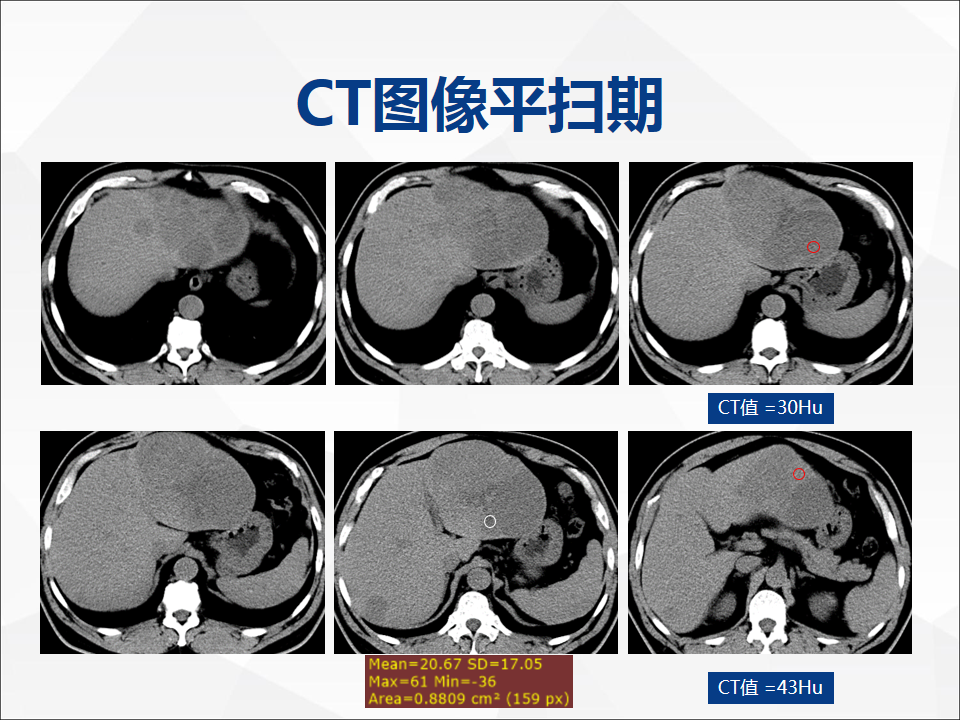 影像PPT - 【病例】肝脏囊性肝细胞肝癌伴转移1例CT及MR-3