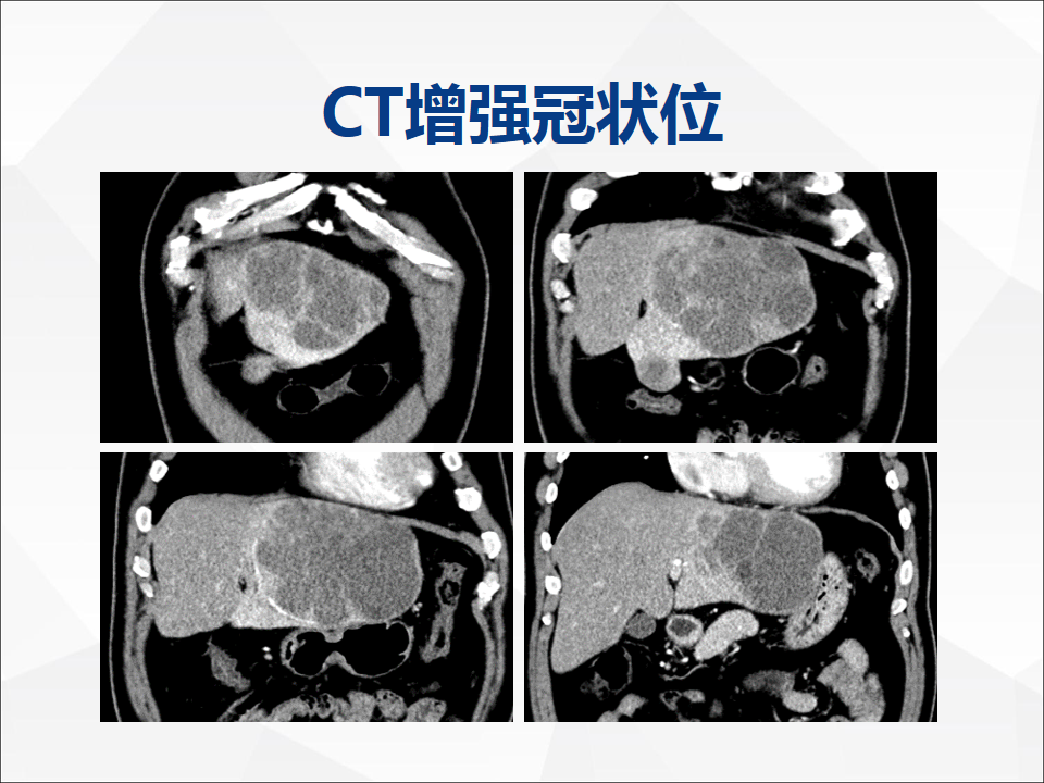 影像PPT - 【病例】肝脏囊性肝细胞肝癌伴转移1例CT及MR-6