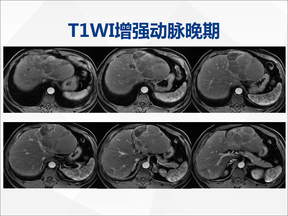 影像PPT - 【病例】肝脏囊性肝细胞肝癌伴转移1例CT及MR-11