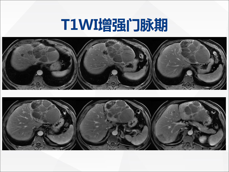 影像PPT - 【病例】肝脏囊性肝细胞肝癌伴转移1例CT及MR-12