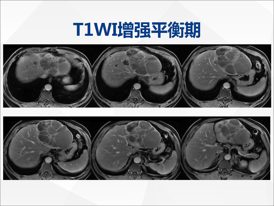 影像PPT - 【病例】肝脏囊性肝细胞肝癌伴转移1例CT及MR-13