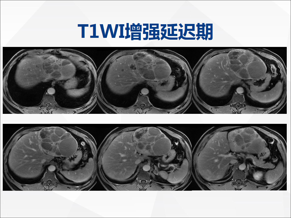 影像PPT - 【病例】肝脏囊性肝细胞肝癌伴转移1例CT及MR-14