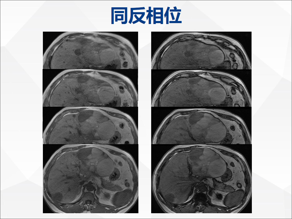 影像PPT - 【病例】肝脏囊性肝细胞肝癌伴转移1例CT及MR-15
