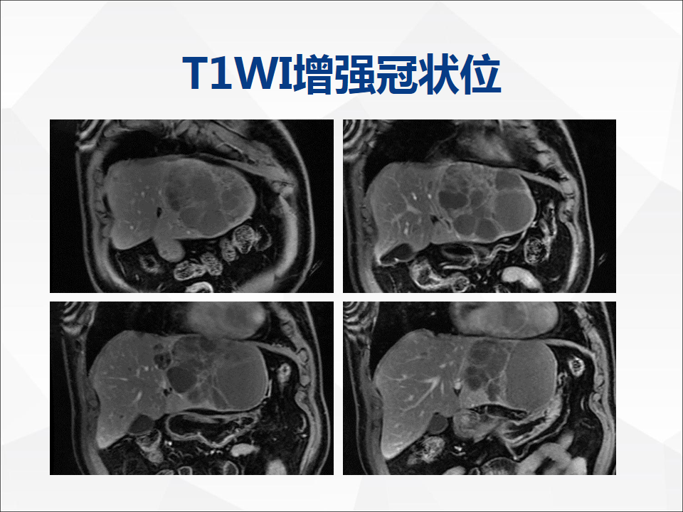 影像PPT - 【病例】肝脏囊性肝细胞肝癌伴转移1例CT及MR-16