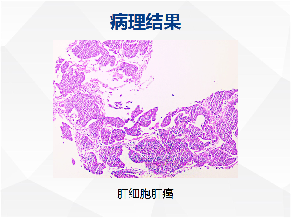 影像PPT - 【病例】肝脏囊性肝细胞肝癌伴转移1例CT及MR-18
