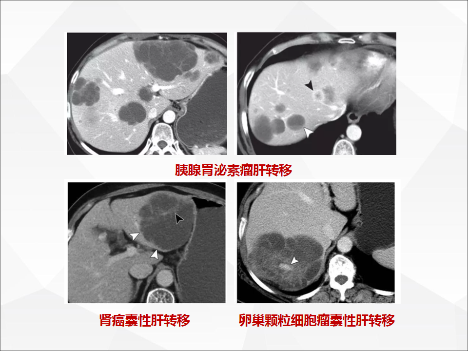 影像PPT - 【病例】肝脏囊性肝细胞肝癌伴转移1例CT及MR-23