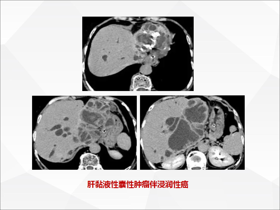 影像PPT - 【病例】肝脏囊性肝细胞肝癌伴转移1例CT及MR-25