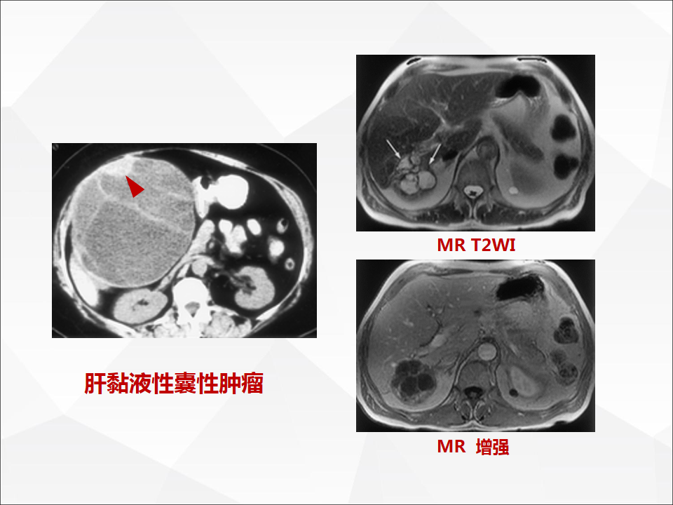 影像PPT - 【病例】肝脏囊性肝细胞肝癌伴转移1例CT及MR-26