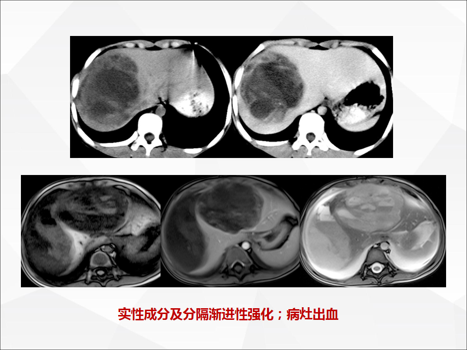 影像PPT - 【病例】肝脏囊性肝细胞肝癌伴转移1例CT及MR-28