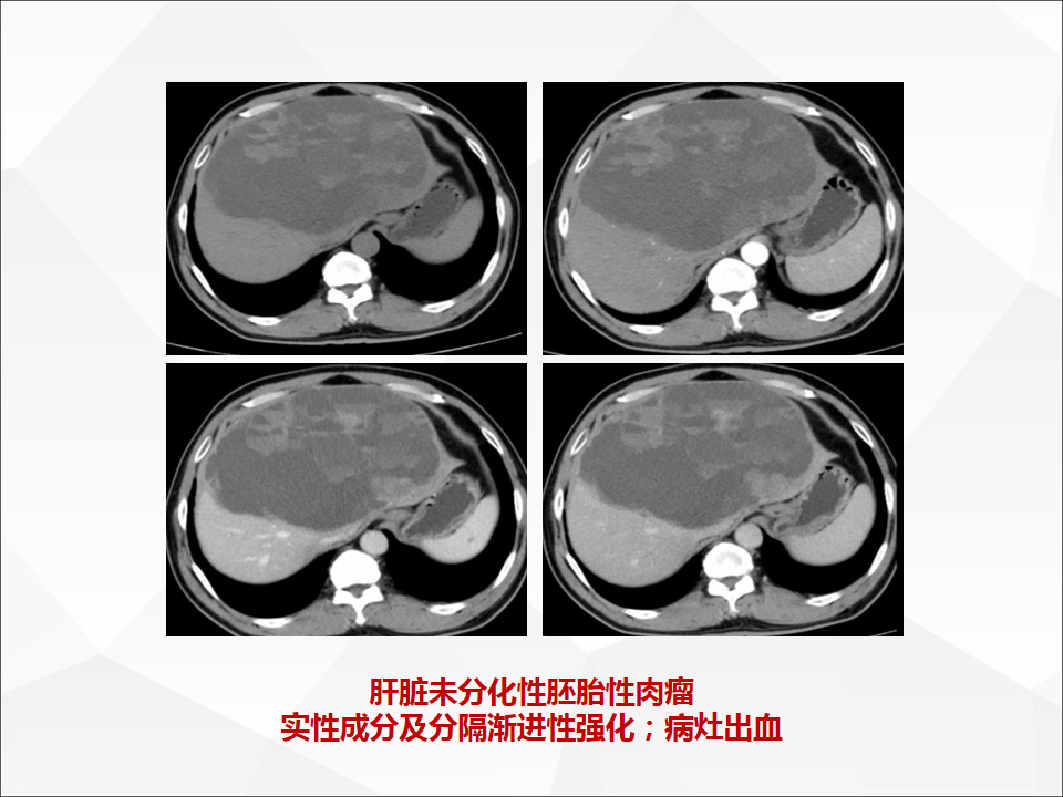 影像PPT - 【病例】肝脏囊性肝细胞肝癌伴转移1例CT及MR-29