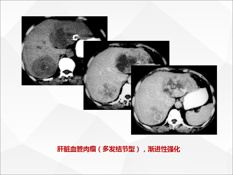 影像PPT - 【病例】肝脏囊性肝细胞肝癌伴转移1例CT及MR-31