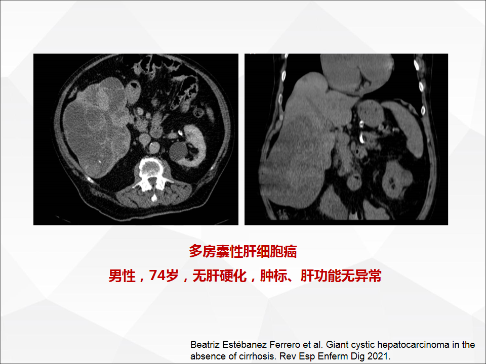 影像PPT - 【病例】肝脏囊性肝细胞肝癌伴转移1例CT及MR-34