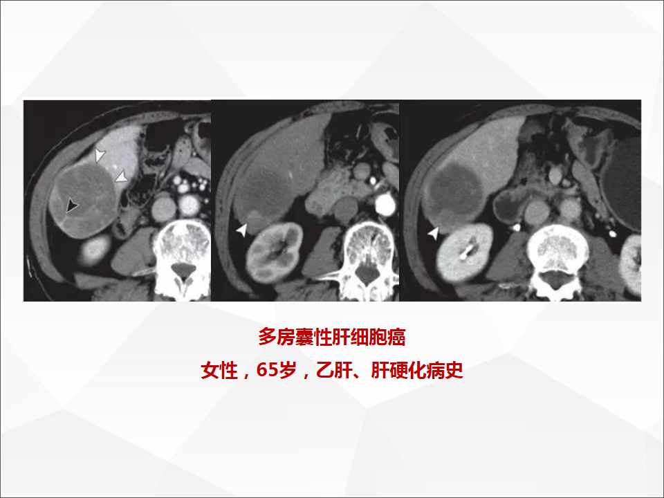 影像PPT - 【病例】肝脏囊性肝细胞肝癌伴转移1例CT及MR-35