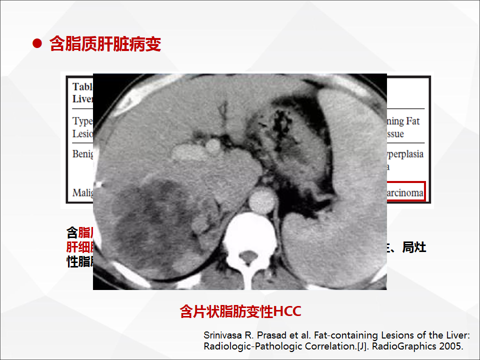 影像PPT - 【病例】肝脏囊性肝细胞肝癌伴转移1例CT及MR-37