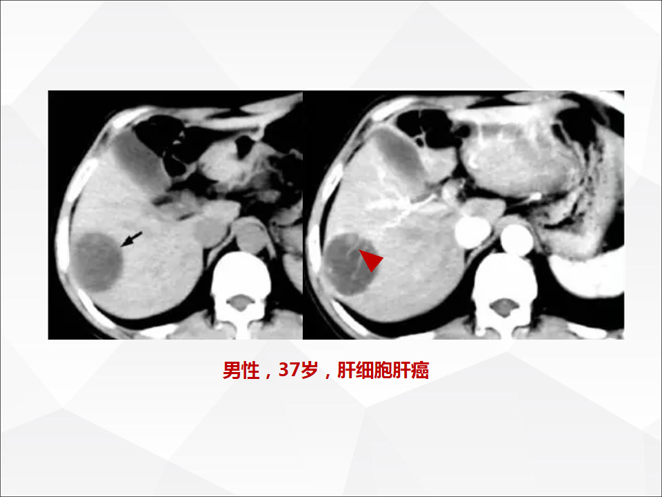 影像PPT - 【病例】肝脏囊性肝细胞肝癌伴转移1例CT及MR-39