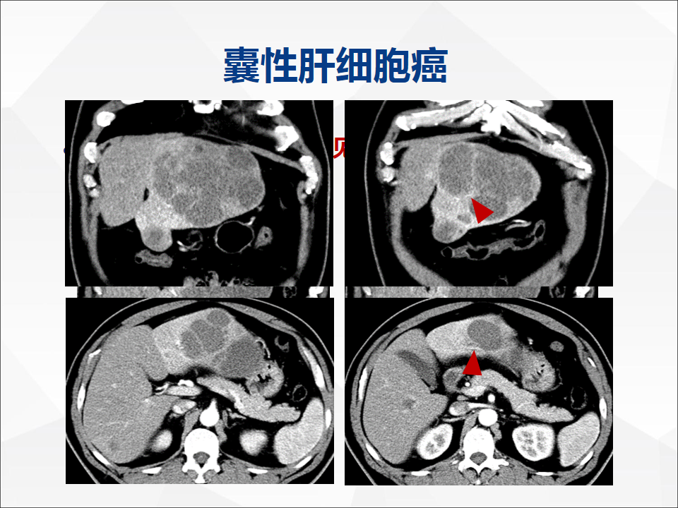 影像PPT - 【病例】肝脏囊性肝细胞肝癌伴转移1例CT及MR-38