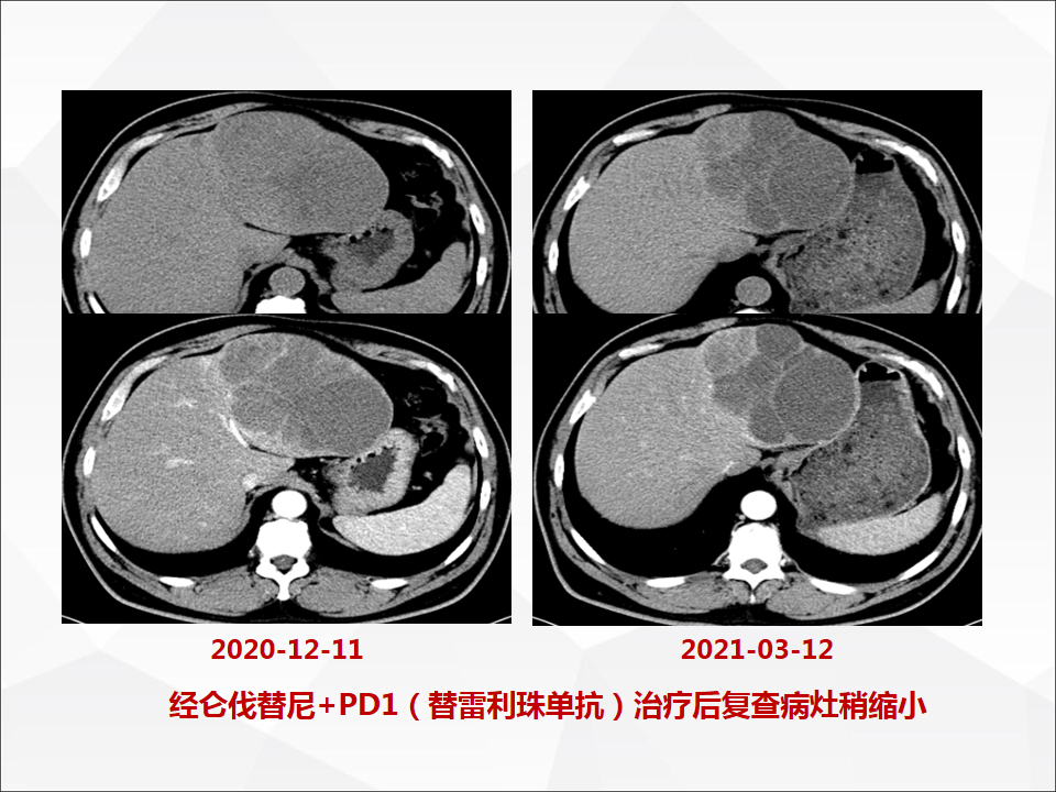 影像PPT - 【病例】肝脏囊性肝细胞肝癌伴转移1例CT及MR-40