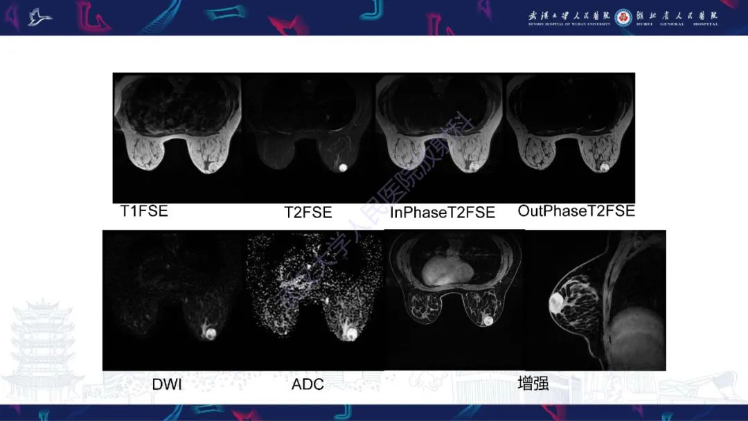 影像PPT - 【PPT】乳腺导管内乳头状瘤影像诊断-3