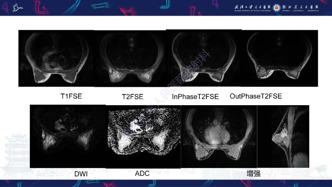 影像PPT - 【PPT】乳腺导管内乳头状瘤影像诊断-5