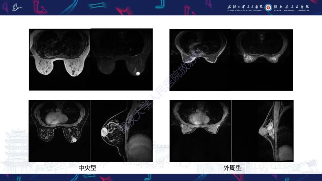 影像PPT - 【PPT】乳腺导管内乳头状瘤影像诊断-12