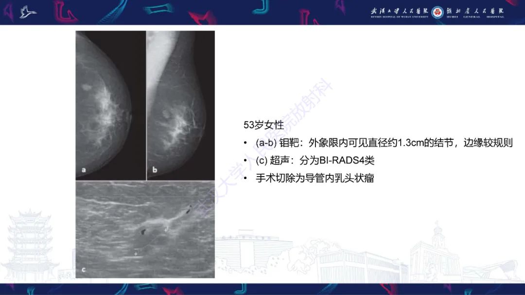影像PPT - 【PPT】乳腺导管内乳头状瘤影像诊断-15