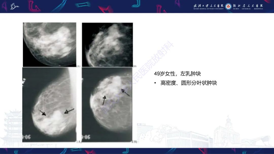 影像PPT - 【PPT】乳腺导管内乳头状瘤影像诊断-16