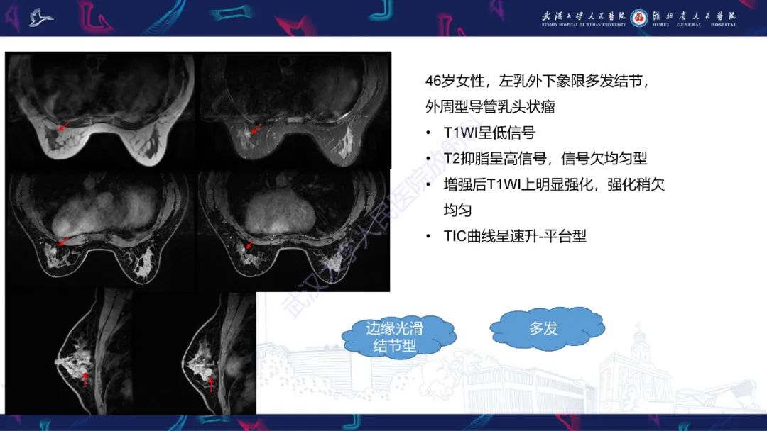 影像PPT - 【PPT】乳腺导管内乳头状瘤影像诊断-18