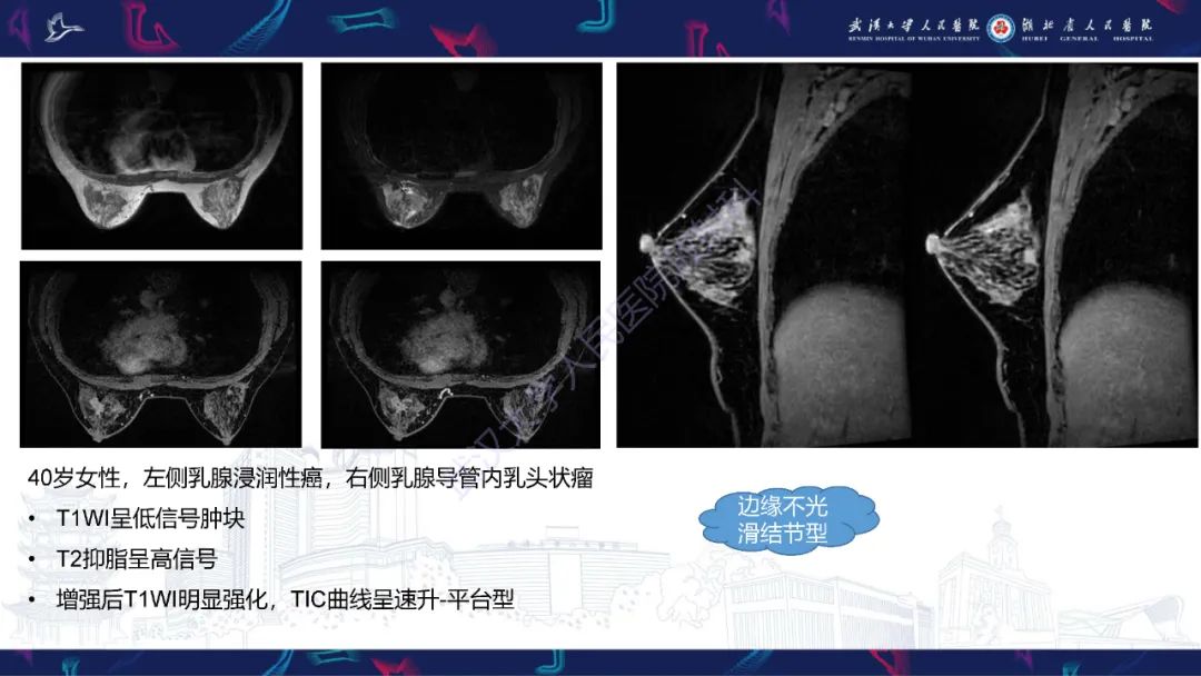 影像PPT - 【PPT】乳腺导管内乳头状瘤影像诊断-19