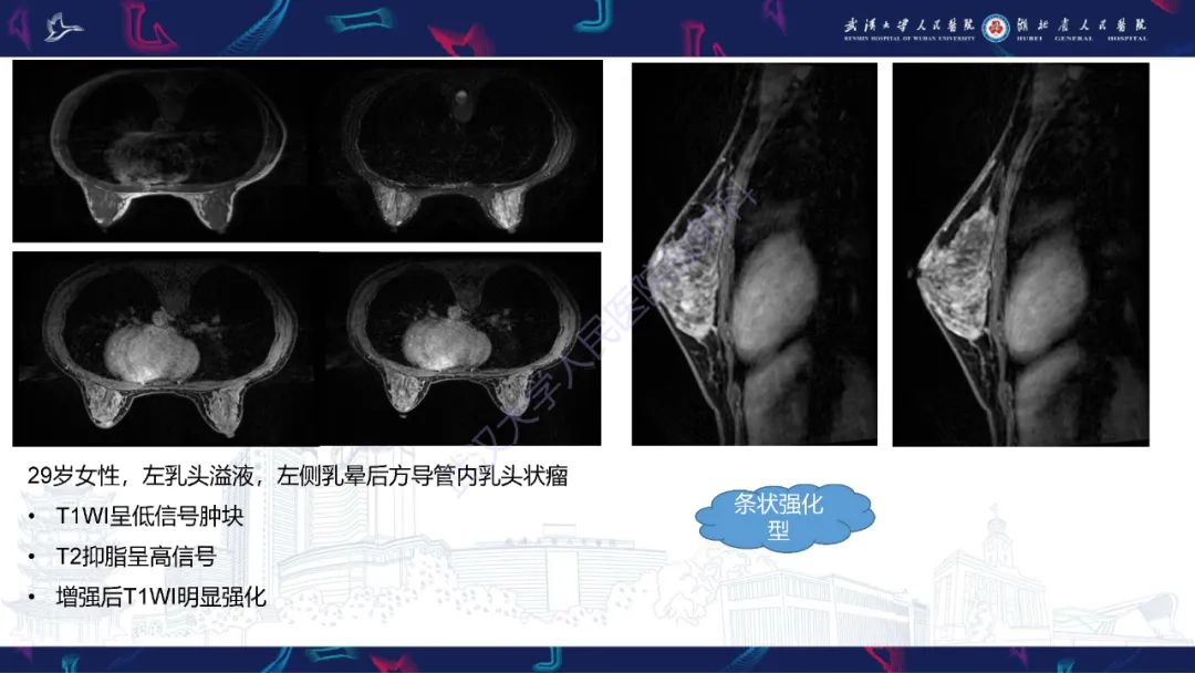 影像PPT - 【PPT】乳腺导管内乳头状瘤影像诊断-20