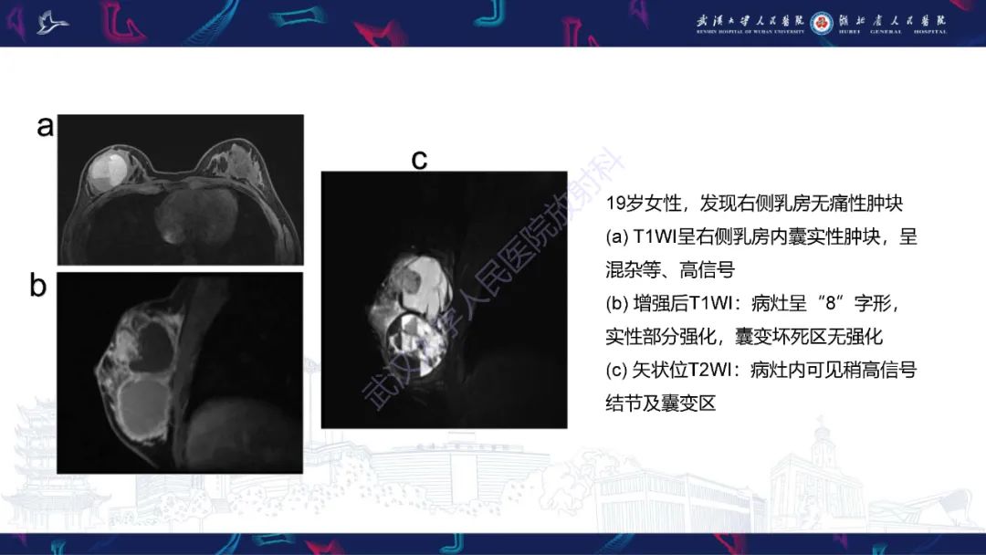 影像PPT - 【PPT】乳腺导管内乳头状瘤影像诊断-22