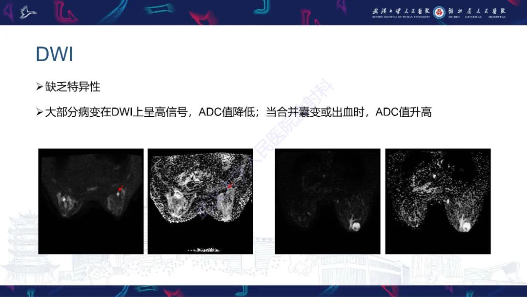影像PPT - 【PPT】乳腺导管内乳头状瘤影像诊断-23