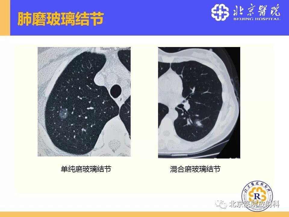 影像PPT - 【PPT】肺磨玻璃结节诊断和应对方法-4