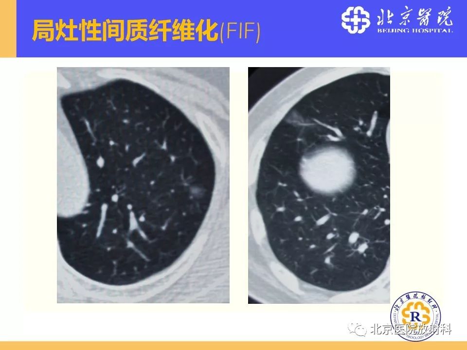 影像PPT - 【PPT】肺磨玻璃结节诊断和应对方法-8