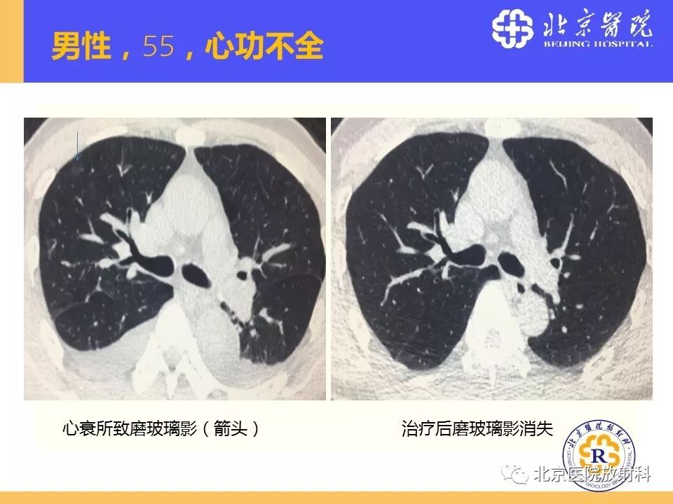 影像PPT - 【PPT】肺磨玻璃结节诊断和应对方法-10