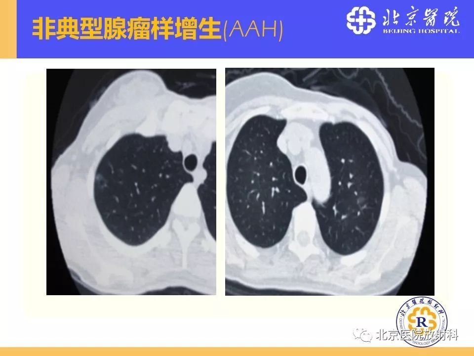 影像PPT - 【PPT】肺磨玻璃结节诊断和应对方法-13