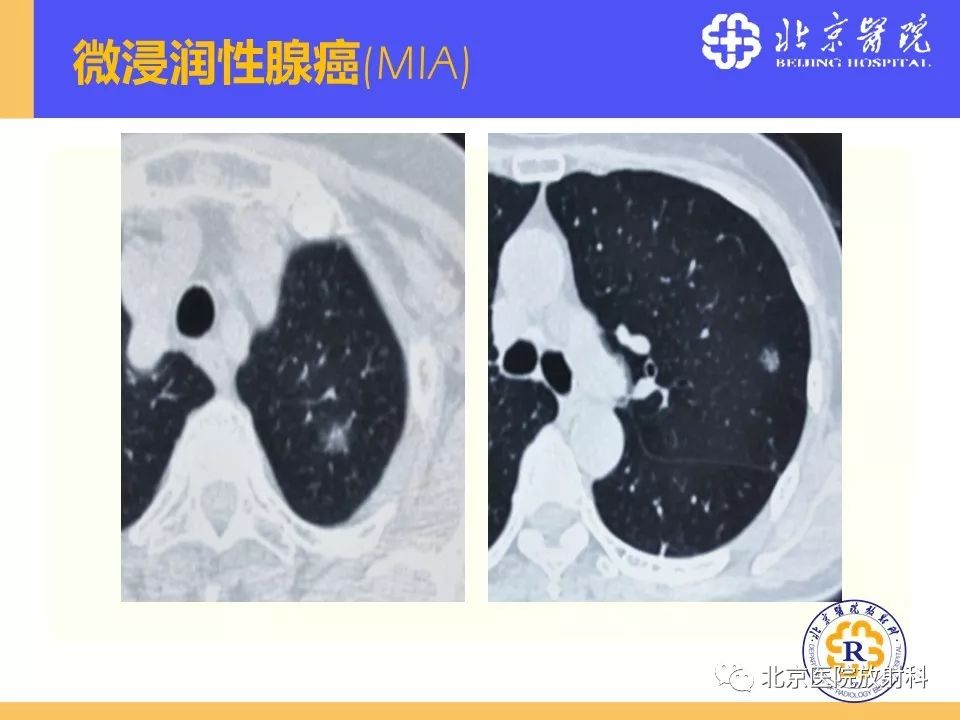 影像PPT - 【PPT】肺磨玻璃结节诊断和应对方法-18