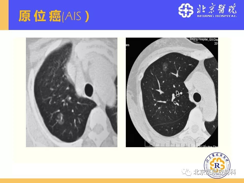影像PPT - 【PPT】肺磨玻璃结节诊断和应对方法-15
