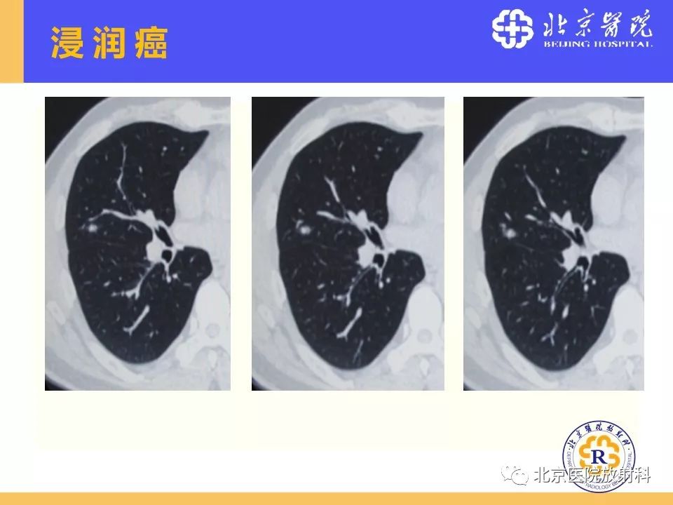 影像PPT - 【PPT】肺磨玻璃结节诊断和应对方法-20