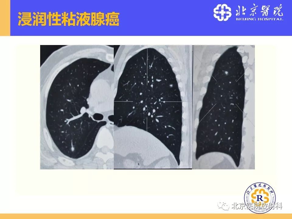影像PPT - 【PPT】肺磨玻璃结节诊断和应对方法-22
