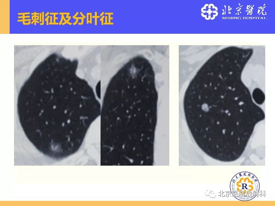 影像PPT - 【PPT】肺磨玻璃结节诊断和应对方法-26