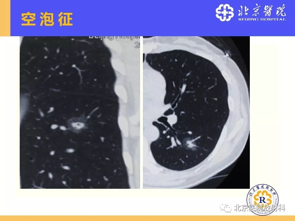 影像PPT - 【PPT】肺磨玻璃结节诊断和应对方法-28