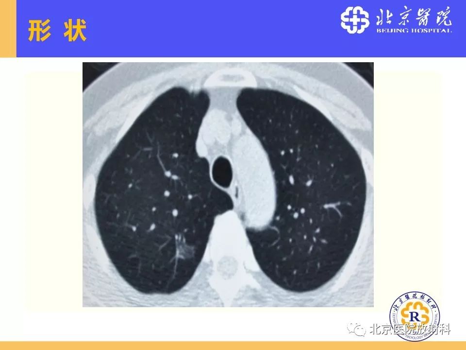 影像PPT - 【PPT】肺磨玻璃结节诊断和应对方法-30