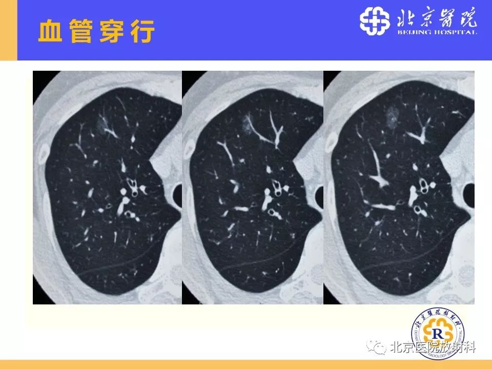 影像PPT - 【PPT】肺磨玻璃结节诊断和应对方法-32