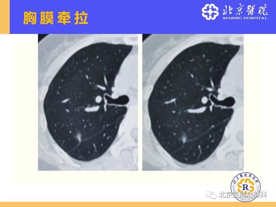 影像PPT - 【PPT】肺磨玻璃结节诊断和应对方法-34