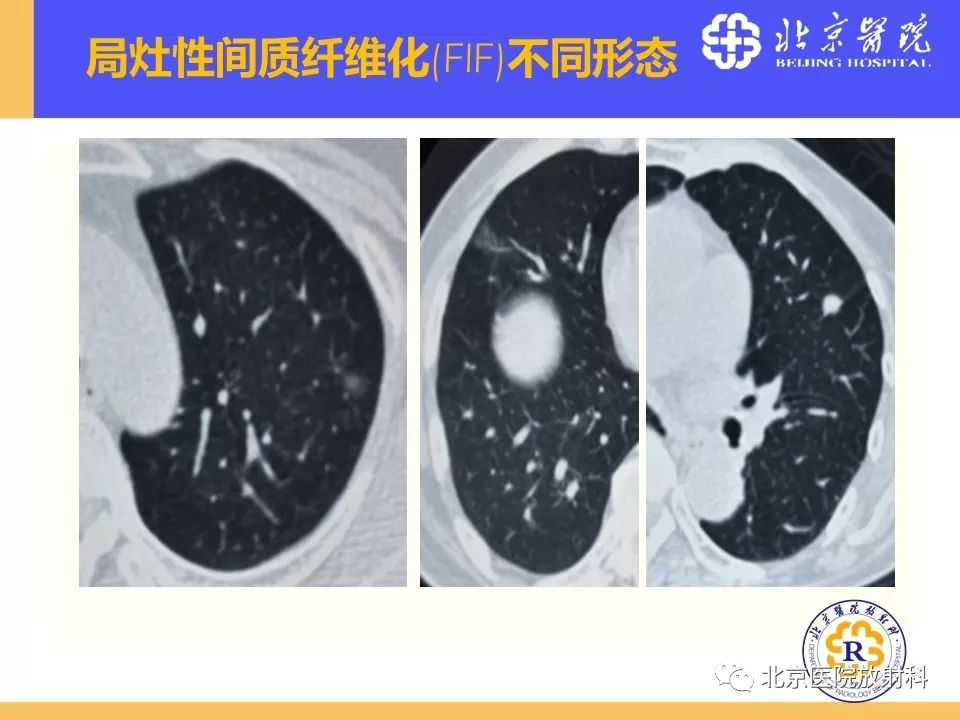 影像PPT - 【PPT】肺磨玻璃结节诊断和应对方法-37