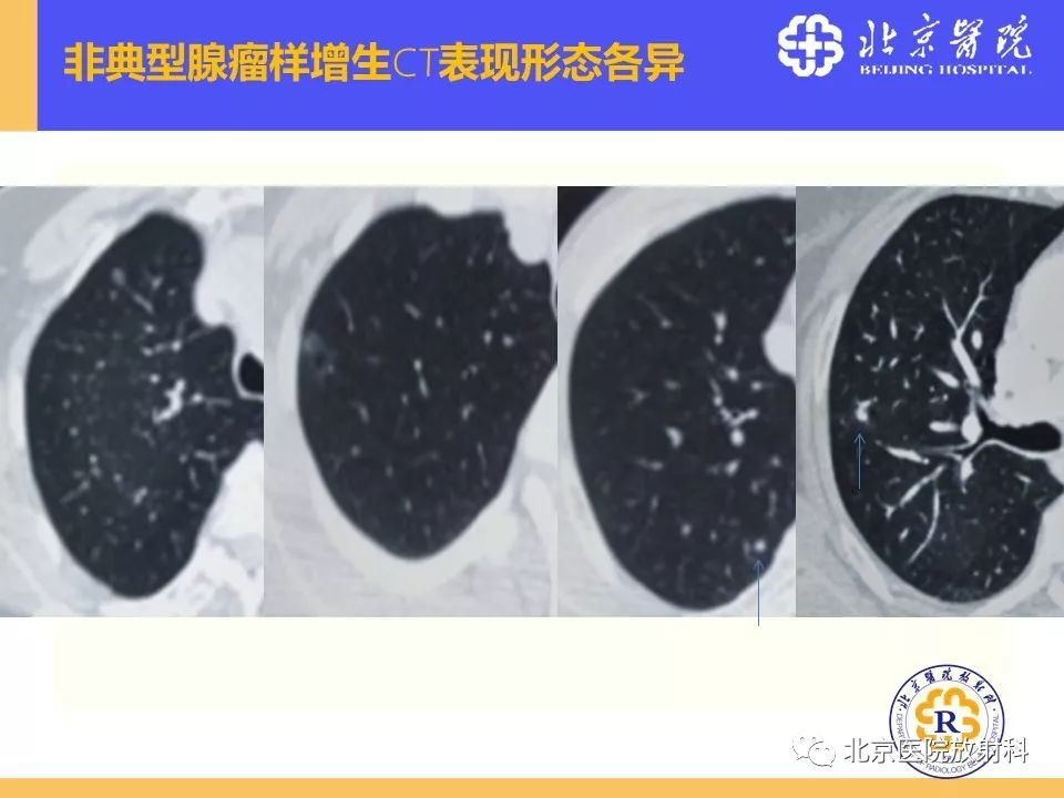 影像PPT - 【PPT】肺磨玻璃结节诊断和应对方法-38